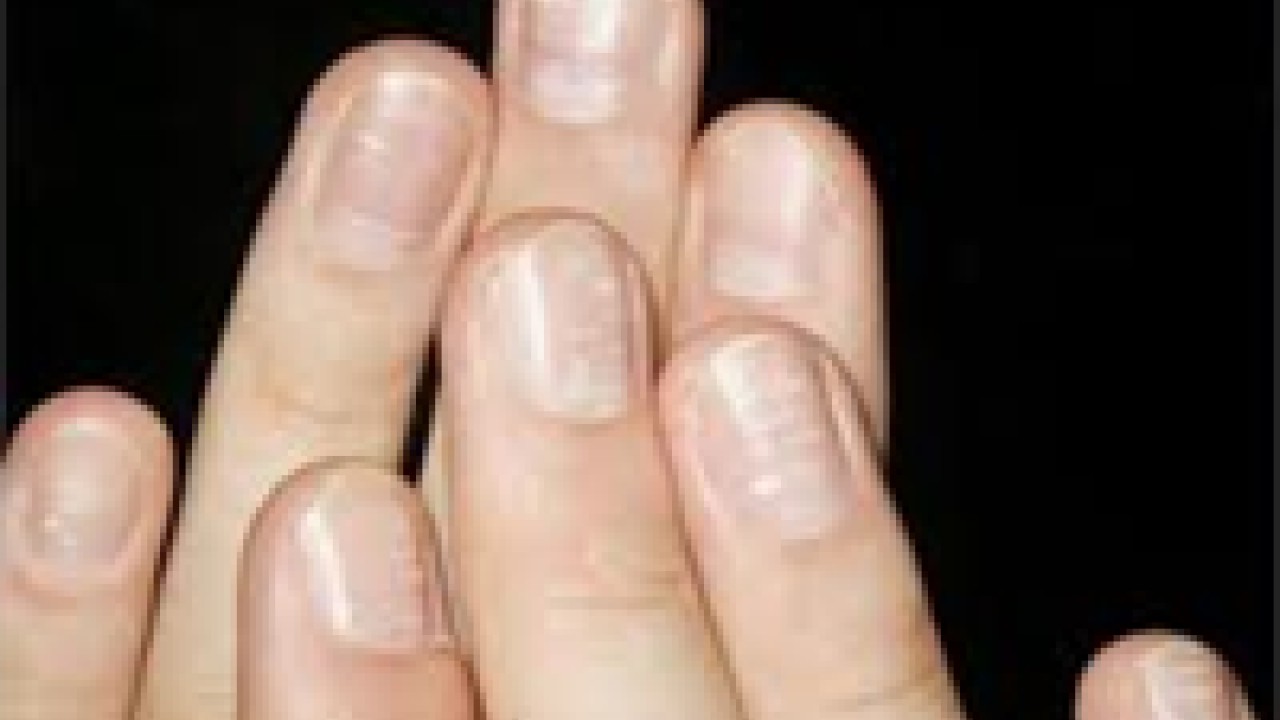 Dấu hiệu cho biết cơ thể đang thiếu kẽm