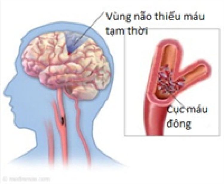 Thiếu máu não có nguy hiểm?