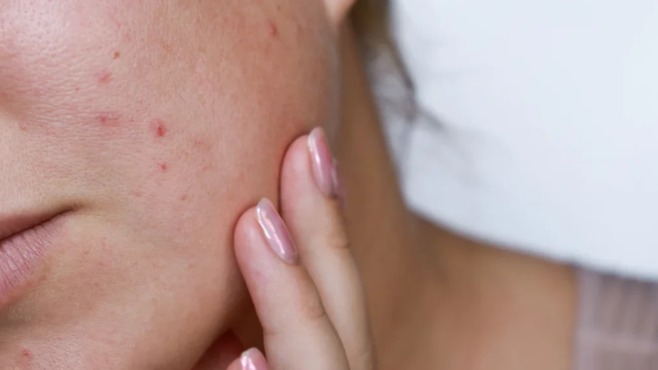 Nguyên nhân dễ nổi mụn khi ăn, uống thực phẩm nhiều đường, ngọt
