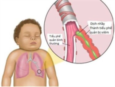 Dấu hiệu mềm sụn thanh quản ở trẻ nhỏ