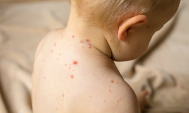 Chickenpox - Old disease, new recommendations
