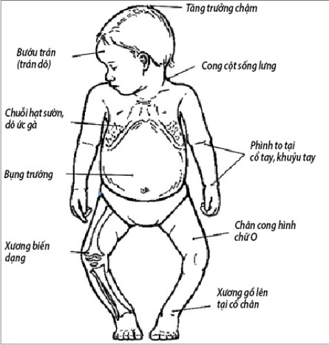 Trẻ nhỏ dễ còi xương, phòng ngừa thế nào?