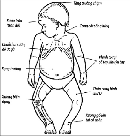 Trẻ nhỏ dễ còi xương, phòng ngừa thế nào?