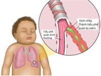 Dấu hiệu mềm sụn thanh quản ở trẻ nhỏ