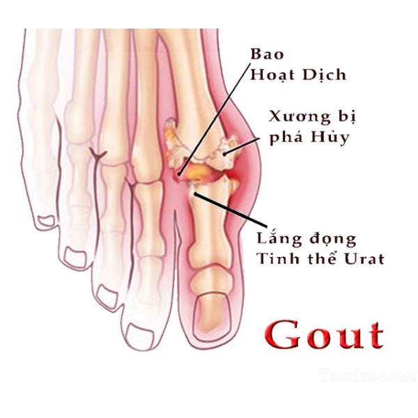 Chế độ ăn dự phòng và điều trị người bị bệnh Gút