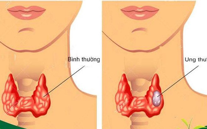 Chế độ dinh dưỡng cho người bệnh ung thư tuyến giáp
